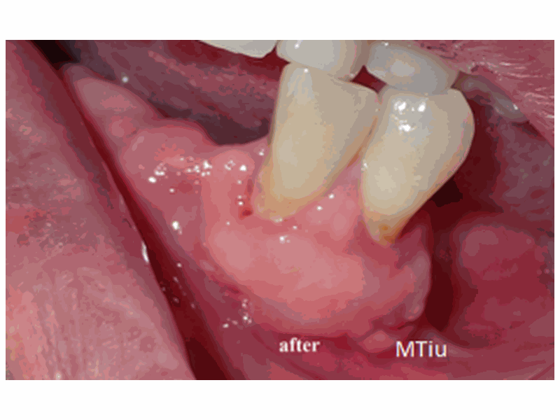 After Gum Graft